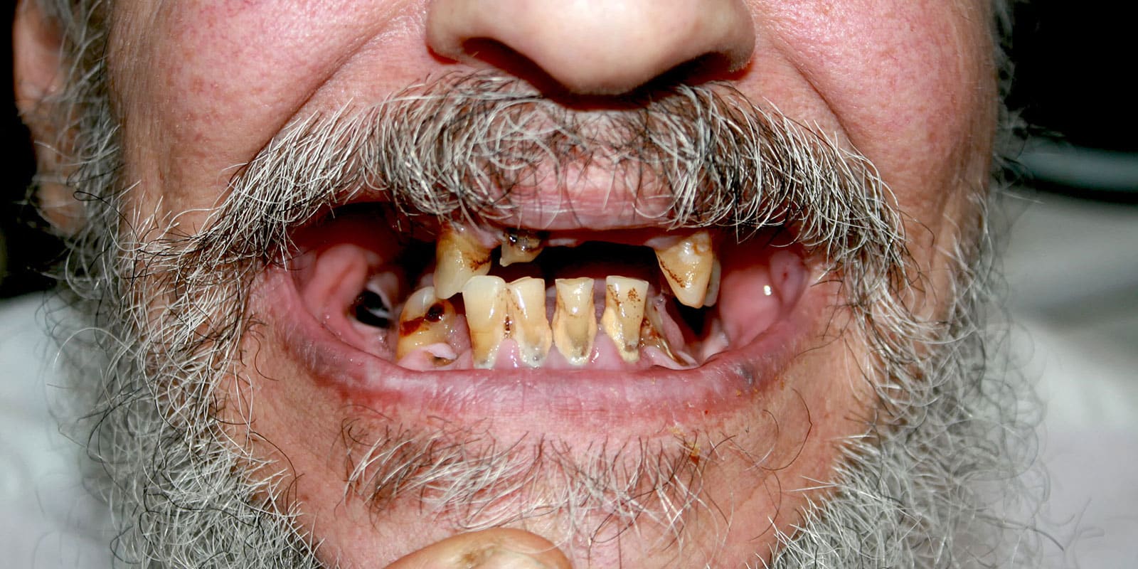 Meth Mouth