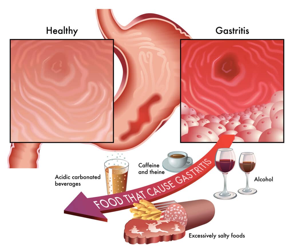 Alcoholic Gastritis